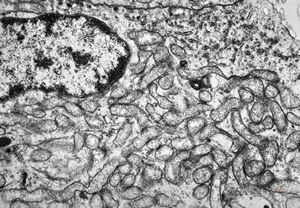 M, 54y. | pituitary adenoma - oncocytic M, 54y. | pituitary adenoma - oncocytic